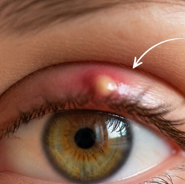 Chalazion : cette petite boule sur la paupière