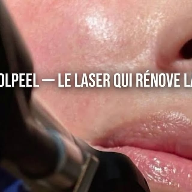 CoolPeel, laser CO2 fractionné pour la peau