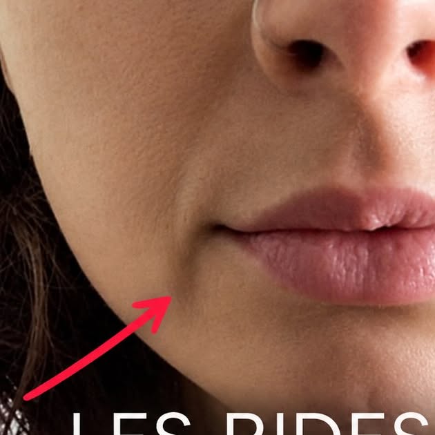 Rides de la marionnette et plis d'amertume du bas du visage