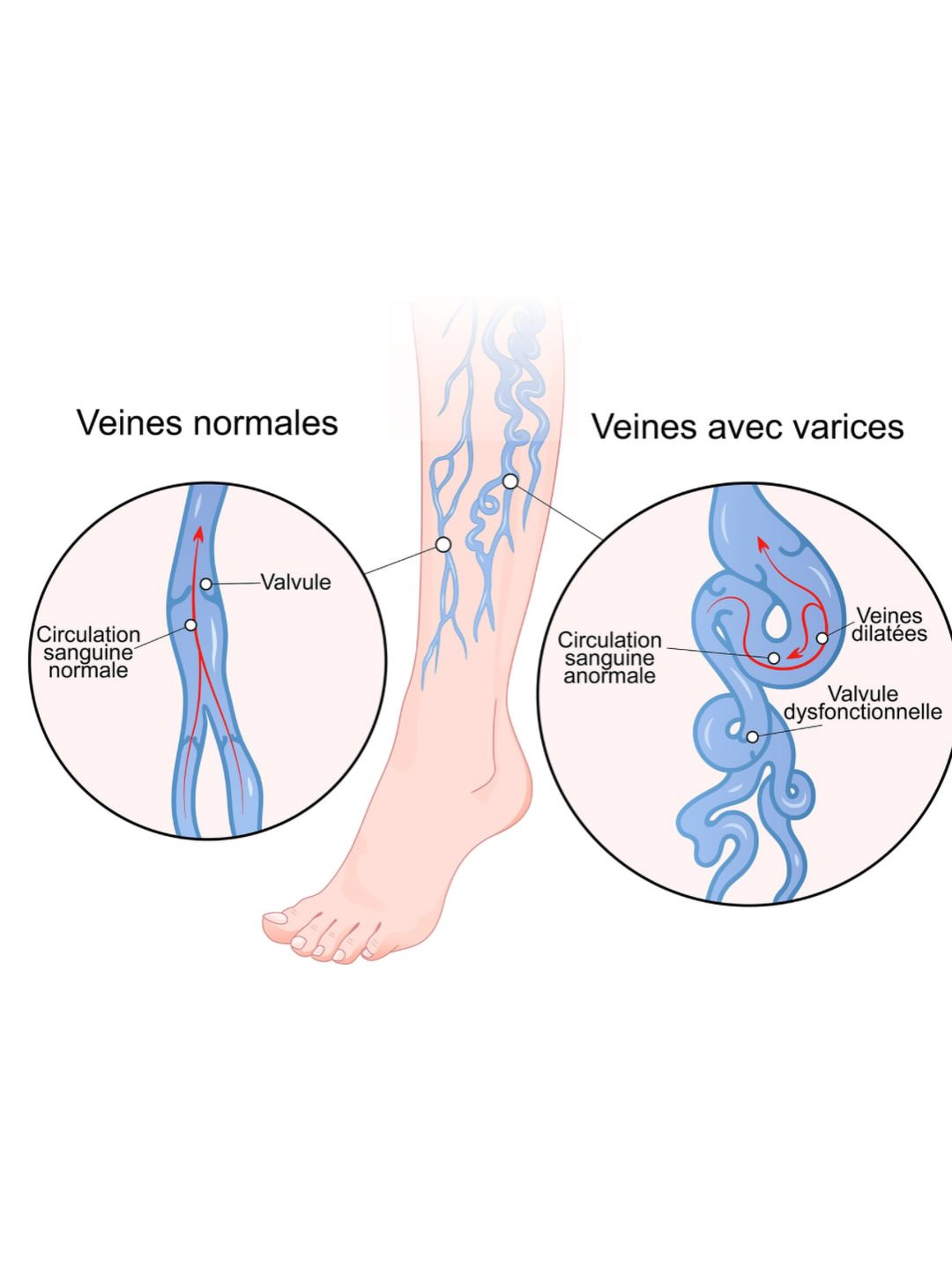 Veines normales vs varices — schéma anatomique valvule